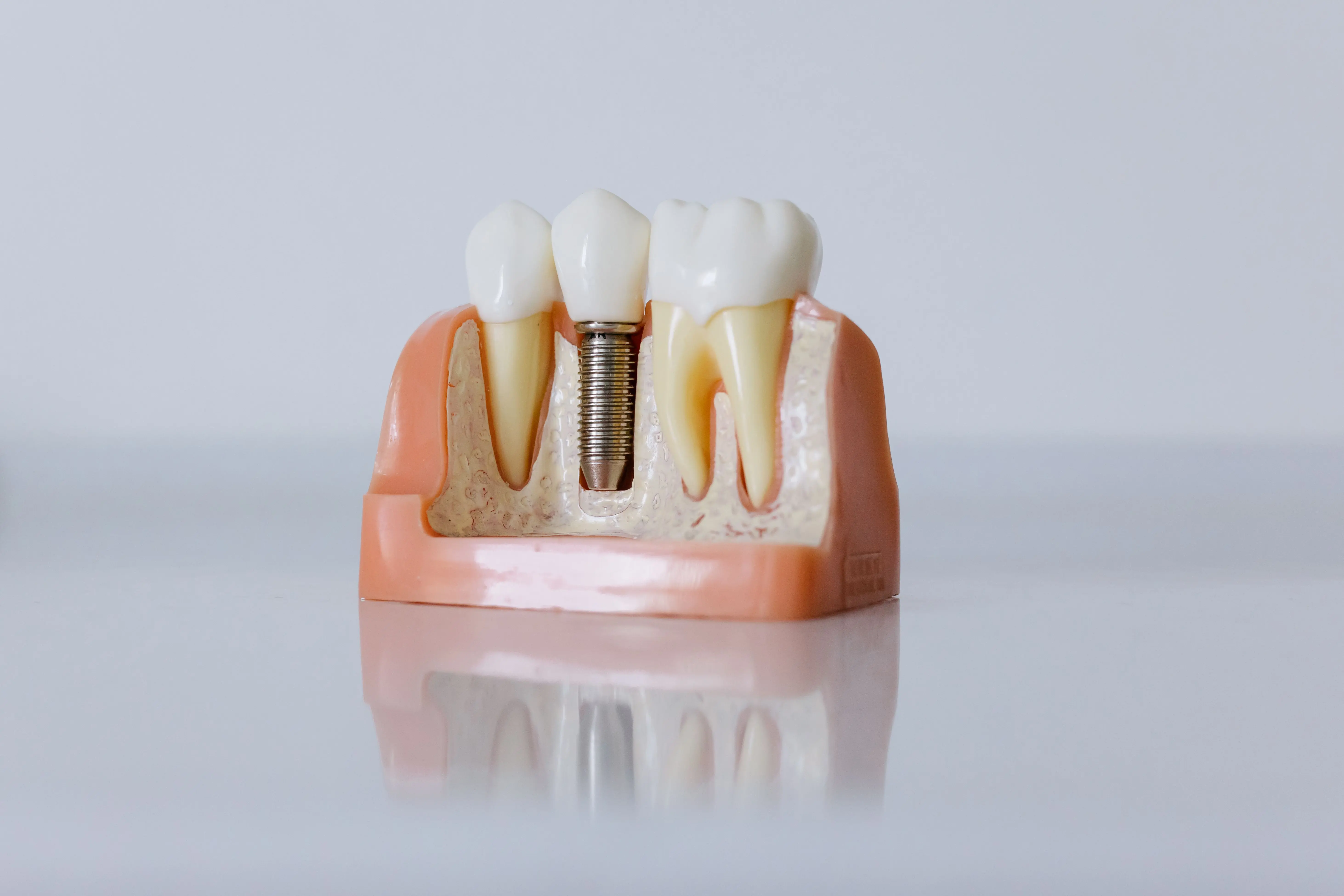 Root Canals